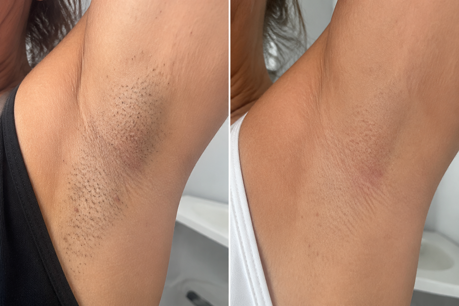 Achselbereich vor und nach der Haarentfernung mit dem Diodenlaser